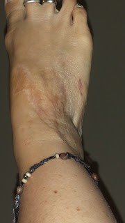 a foot scar