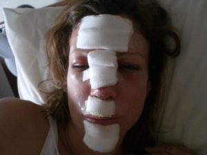 lady wearing bandages on her face after a motorcycle accident