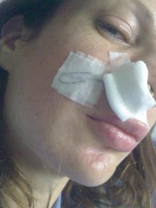 women with dressing in her nose after an accident