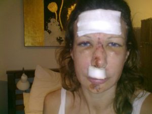 woman with a lot of facial injuries after an accident. She has bandages. motorcycle accident in Thailand