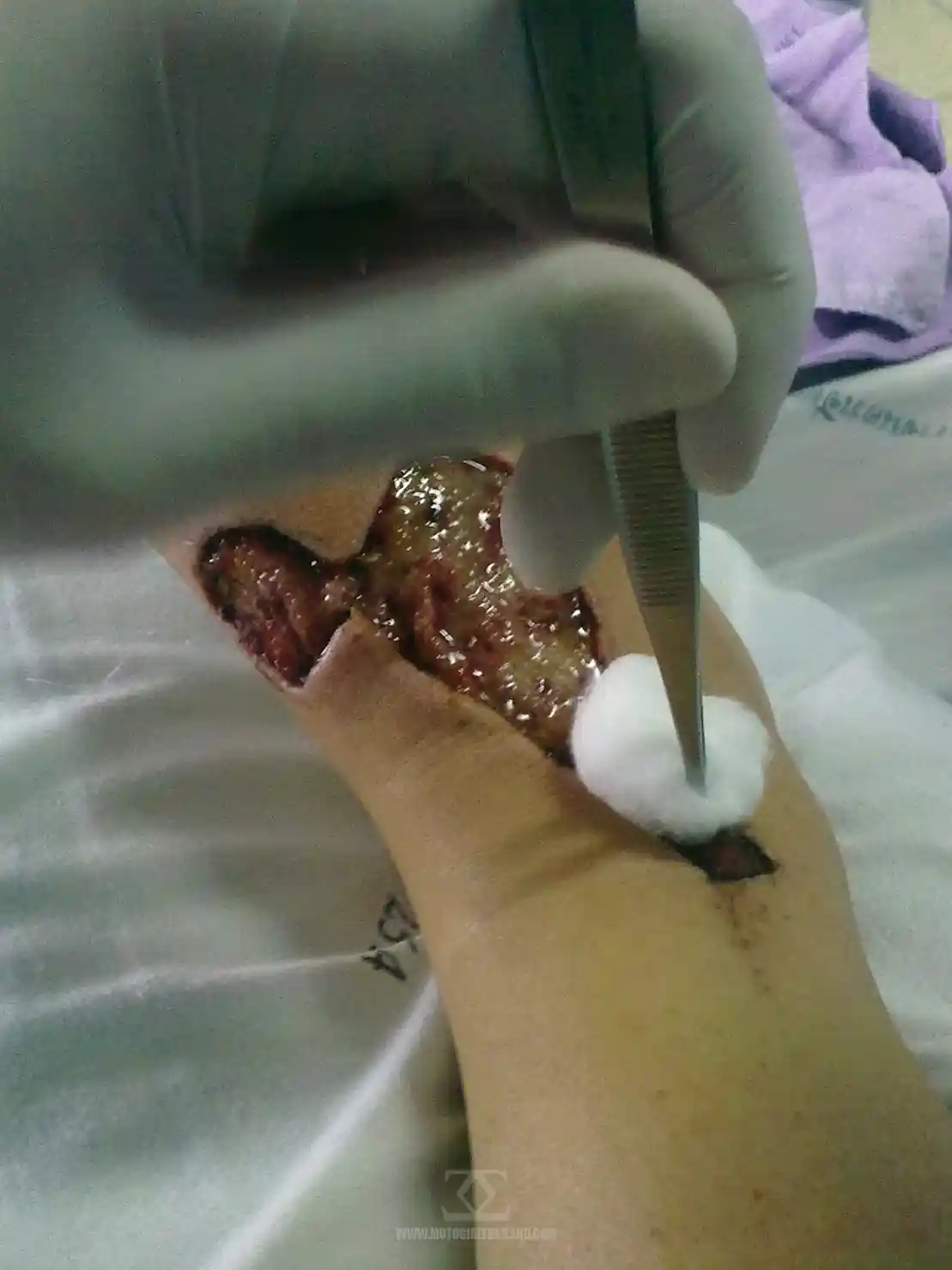 Accident July 2011