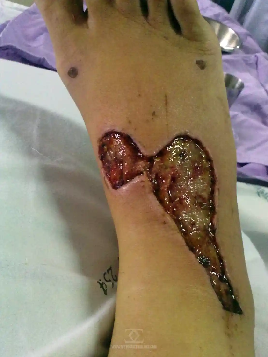 Accident July 2011